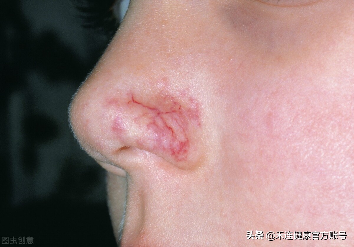 血管痣一般不会对人体健康构成很大危害,但是也尽量不要去抠它,搓它