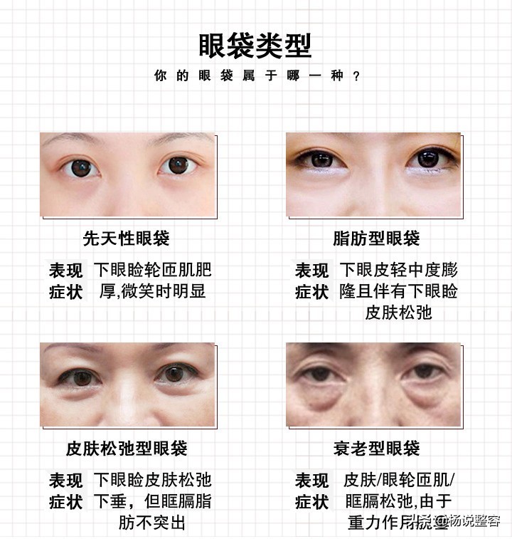 眼袋类型