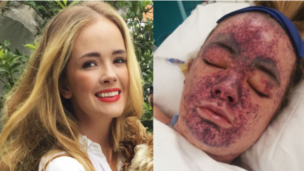 25岁女子泡澡感染致病细菌！医生：不得不截肢