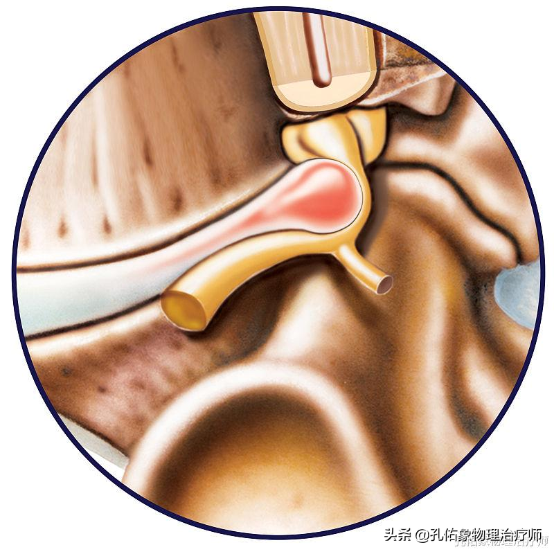 腰椎间盘突出的朋友，为何反复治不好？手术就能解决？告知您内幕