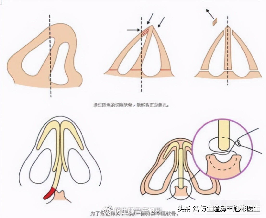 歪鼻矫正怎么做？术后如何护理？会不会反弹？