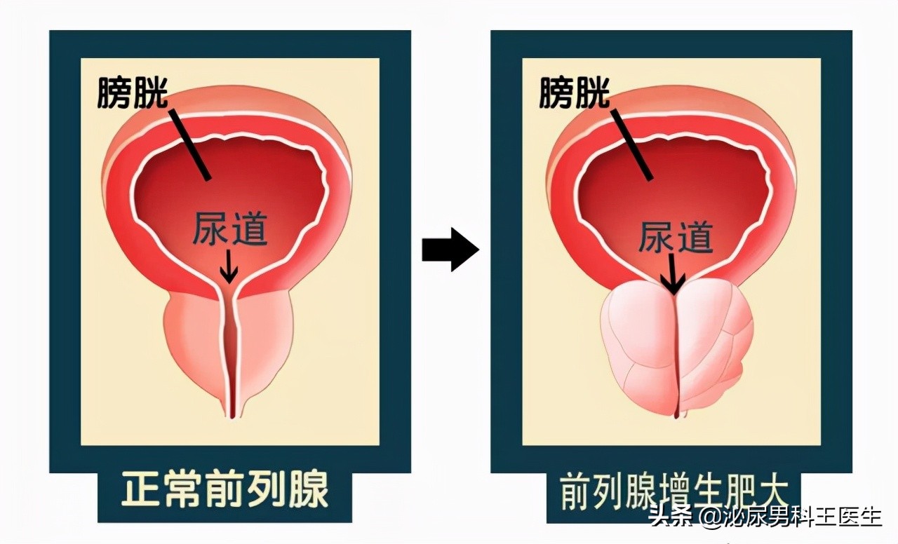 中老年人得了前列腺增生应该怎么办？