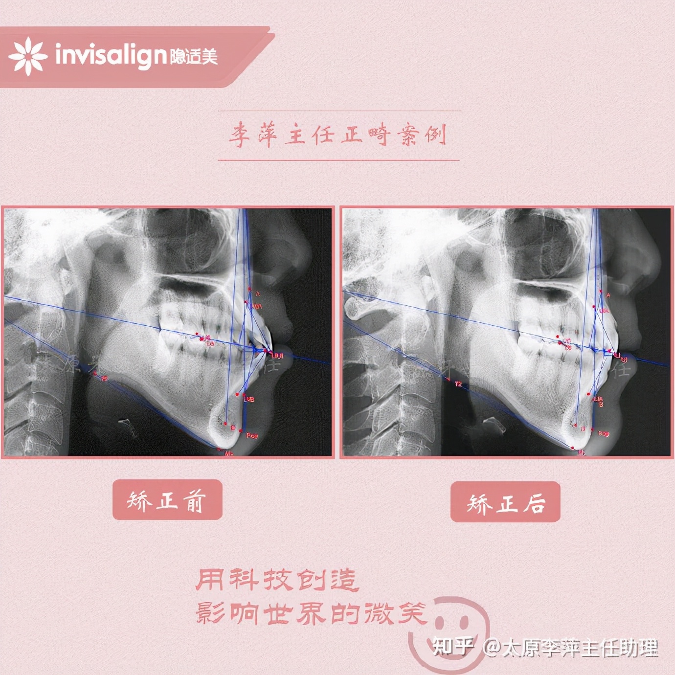 太原牙齿矫正：隐形牙套效果好不好？看这些病例你就知道了