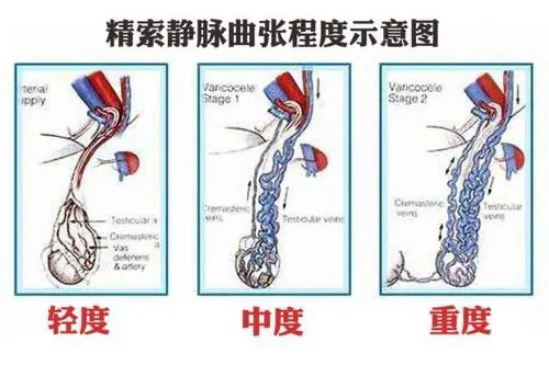 精索静脉曲张手术费图片