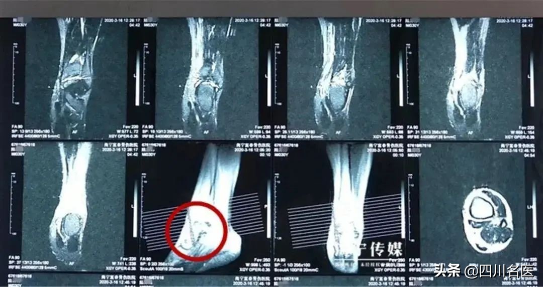 男子崴了脚不当回事，半年后，可怕的一幕出现了…