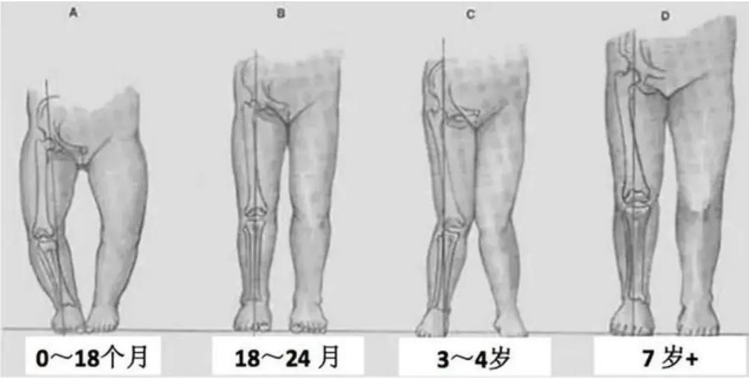 宝宝O型腿、X型腿和过早站有关？如何辨别、矫正？一篇讲明白