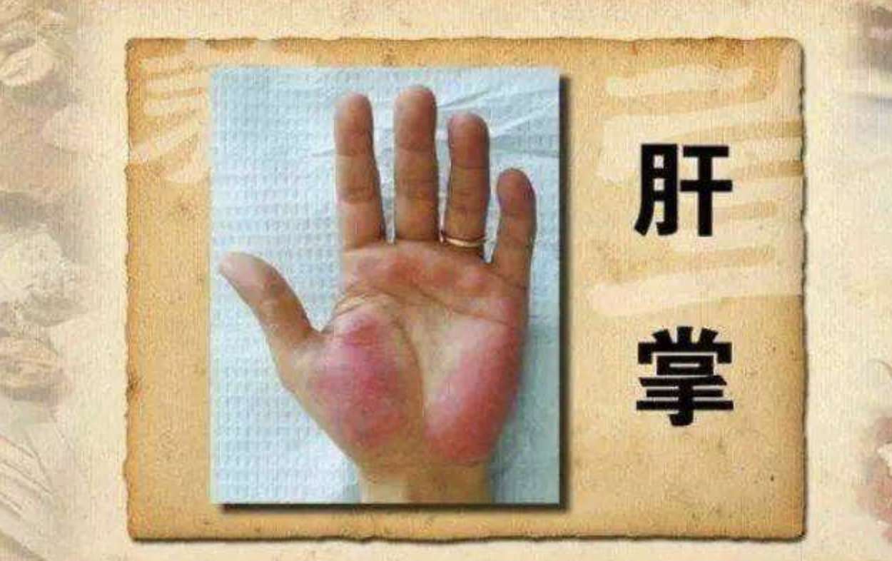 肝掌是指手掌的大小鱼际部位皮肤出现红色斑点的一种现象,所谓大鱼际