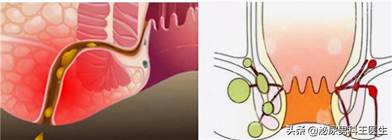 肛瘘患者：“不想治了，我真的太痛了！”肛瘘手术到底有多痛？