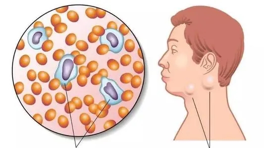 淋巴结肿大又是怎么回事?医生解释清楚