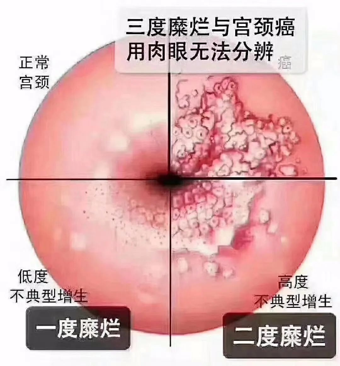 宫颈糜烂怎么办(宫颈糜烂到底要不要治疗)-侠客头条