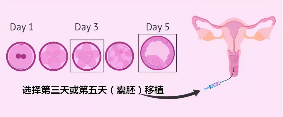 疤痕子宫——再次生育，移植几个胚胎最好？