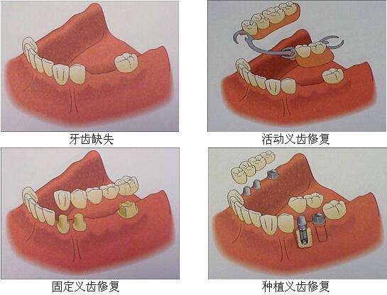 有假牙还可以进行矫正吗？需要先处理假牙吗？听听牙医怎么说