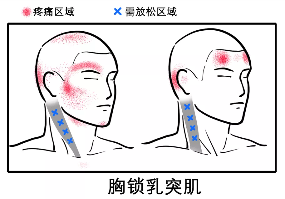 八成头痛和颈椎有关!一份“疼痛位置图解”帮你对症放松