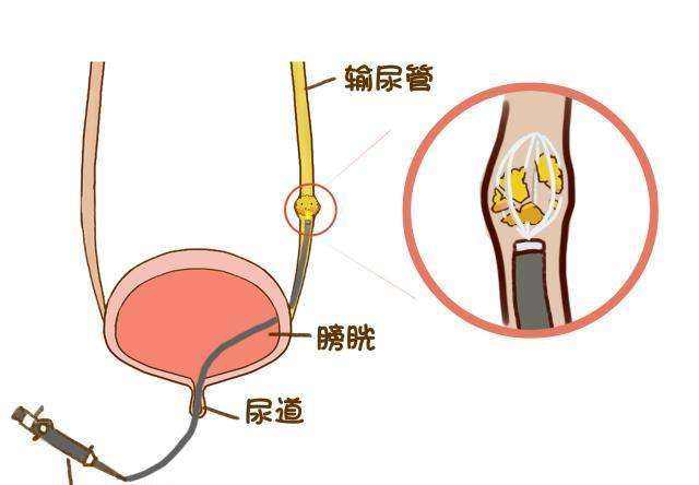 有一种病平时不疼，发作的时候比生孩子还疼，好发于年轻男性