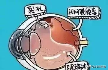 追剧追到凌晨三点 女子视网膜脱落!高度近视人群尤其小心!