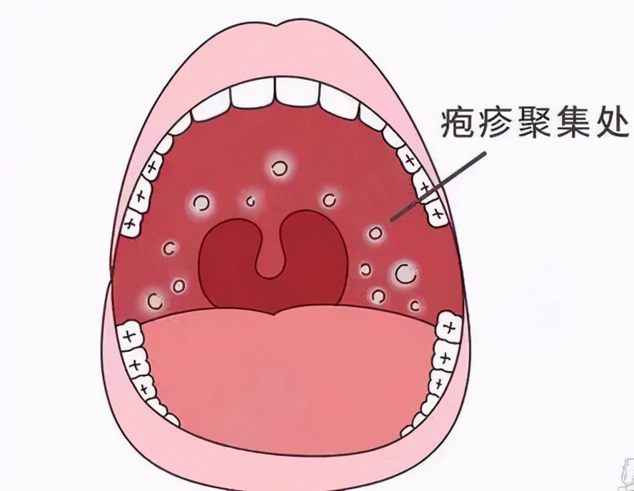 疱疹性咽峡炎高发期，孩子5岁前易中招！医生建议家长速看