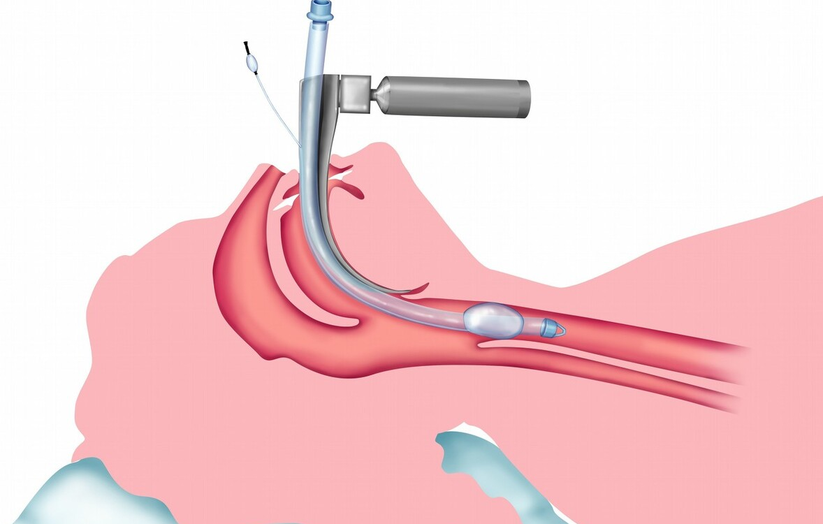 气管插管图片(管子越多) - 赤虎壹号
