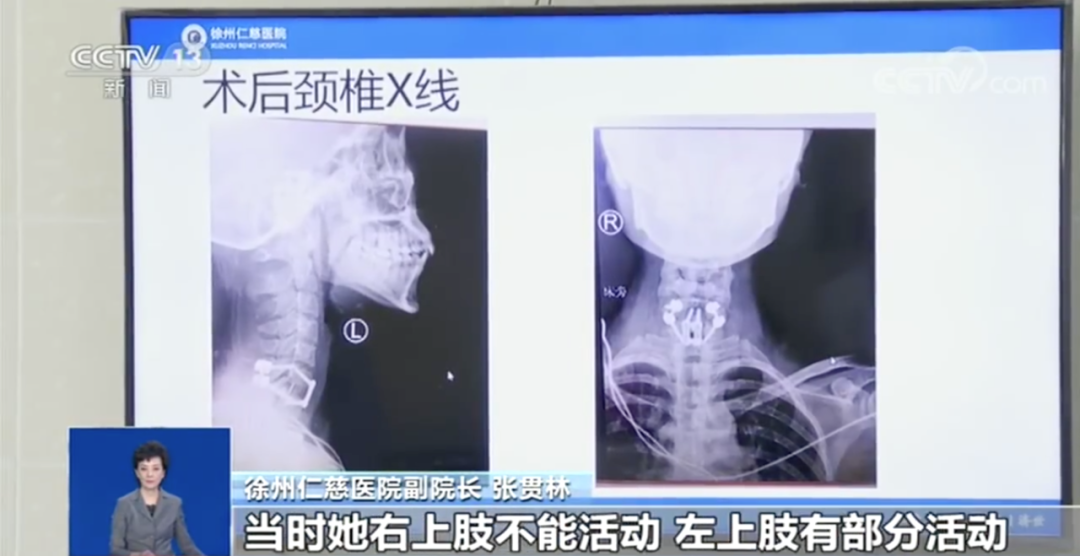 女研究生玩“人体炸弹”摔成完全性截瘫，记者现场调查→