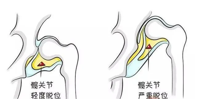 您的髋关节发育正常吗？4 个问题，带你认识髋关节发育不良