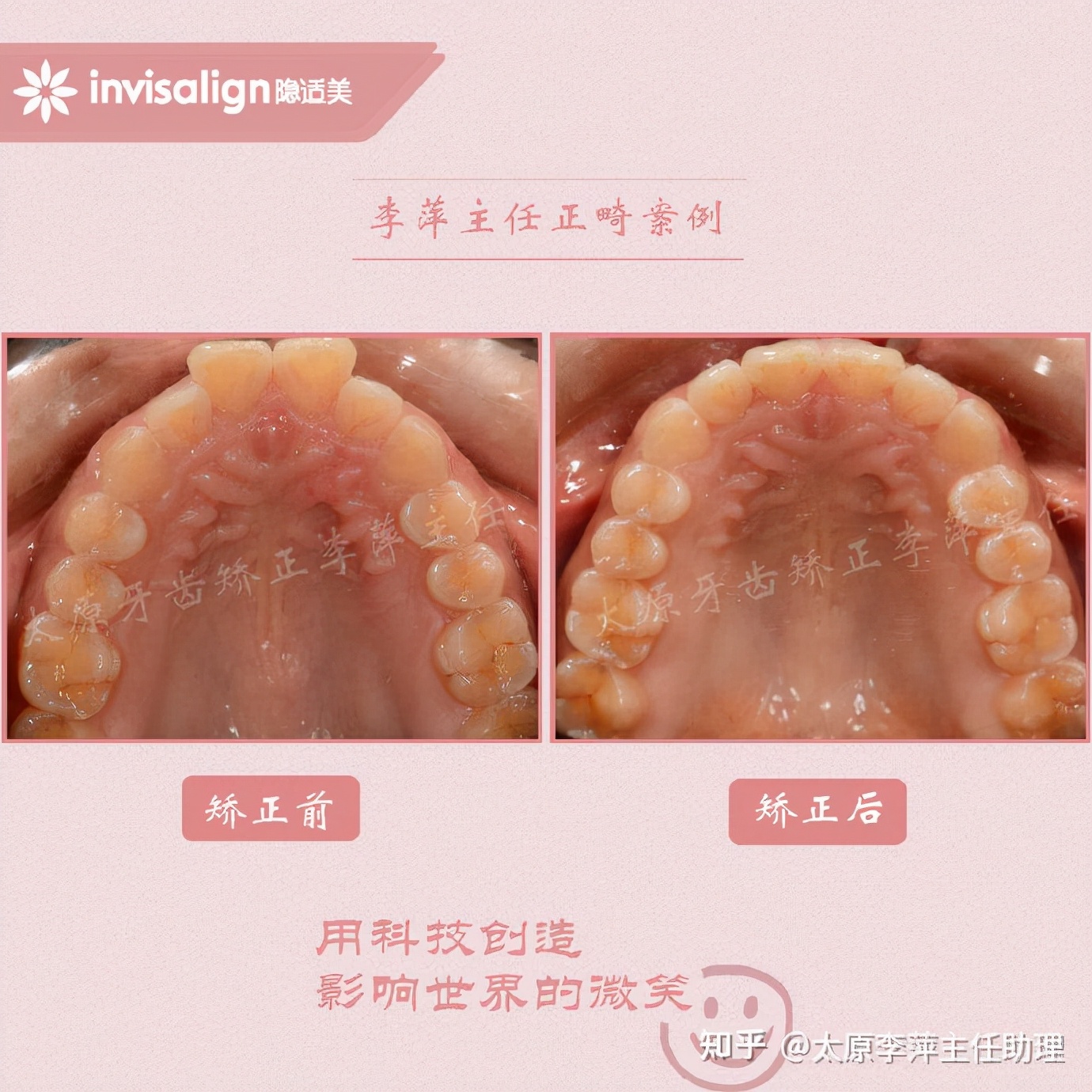 太原牙齿矫正：隐形牙套效果好不好？看这些病例你就知道了
