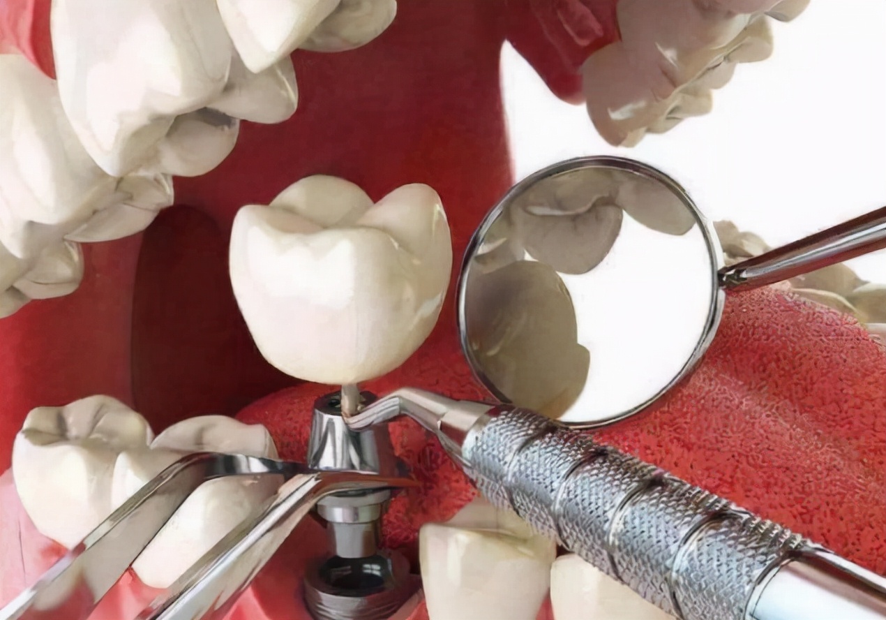 补牙的树脂能用多久？深圳补牙大概需要多少钱一颗？_深圳爱康健口腔医院