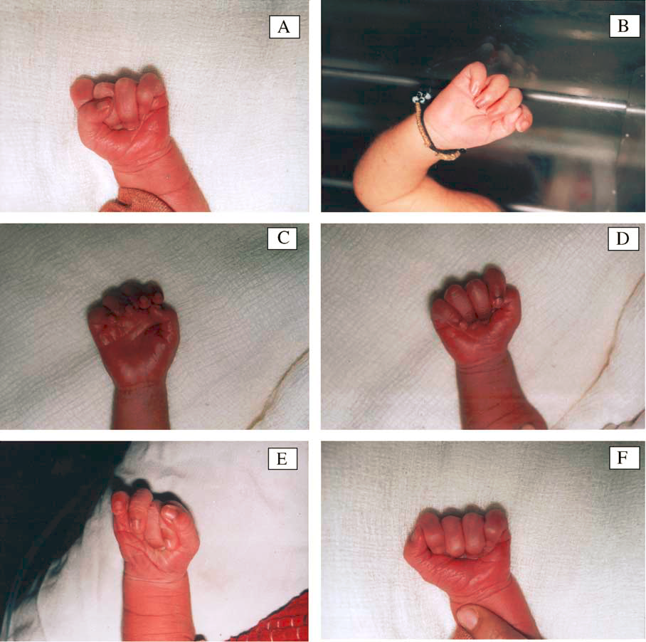 婴儿脑瘫身体发硬图片图片