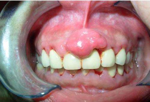 牙龈上长了个瘤子怎么办?不疼不痒会影响健康吗?听听牙医怎么说