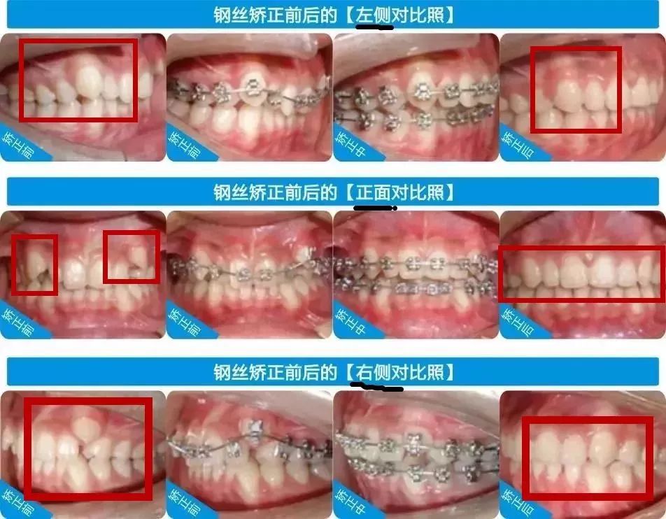 省钱选择“钢丝矫正”，这些你事情需要知晓