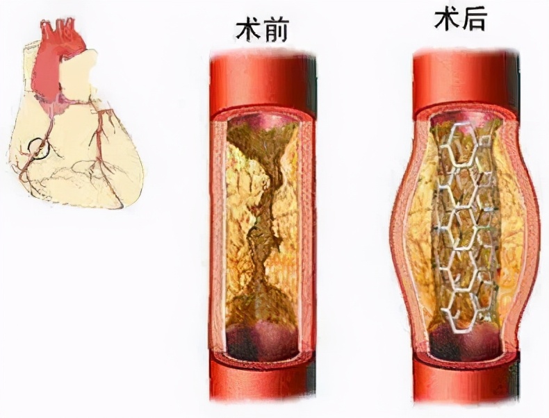 心脏支架手术多少钱？