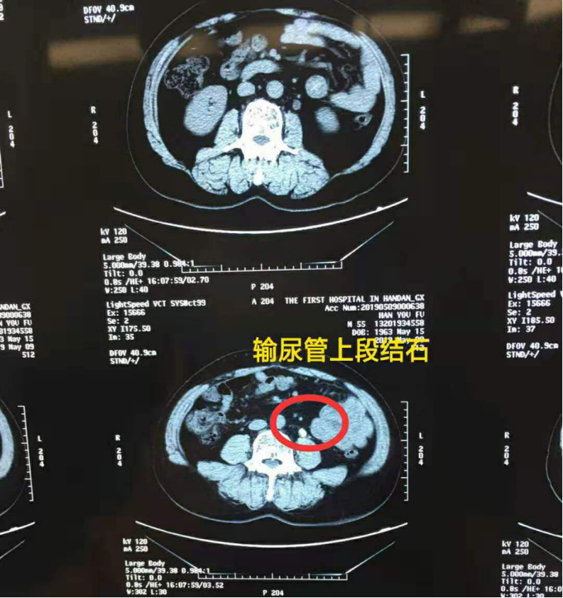 尿路结石不一定非要手术，4个保守治疗的条件需看懂