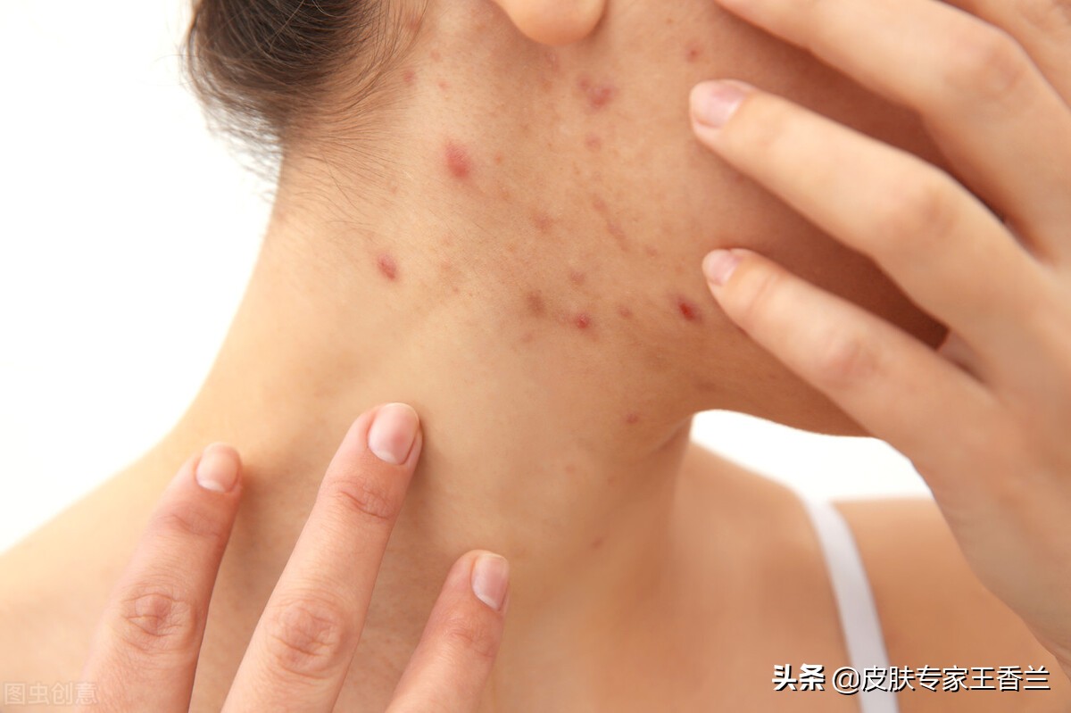 脸上挤出来“白色条状物”是什么东西？有办法去除吗