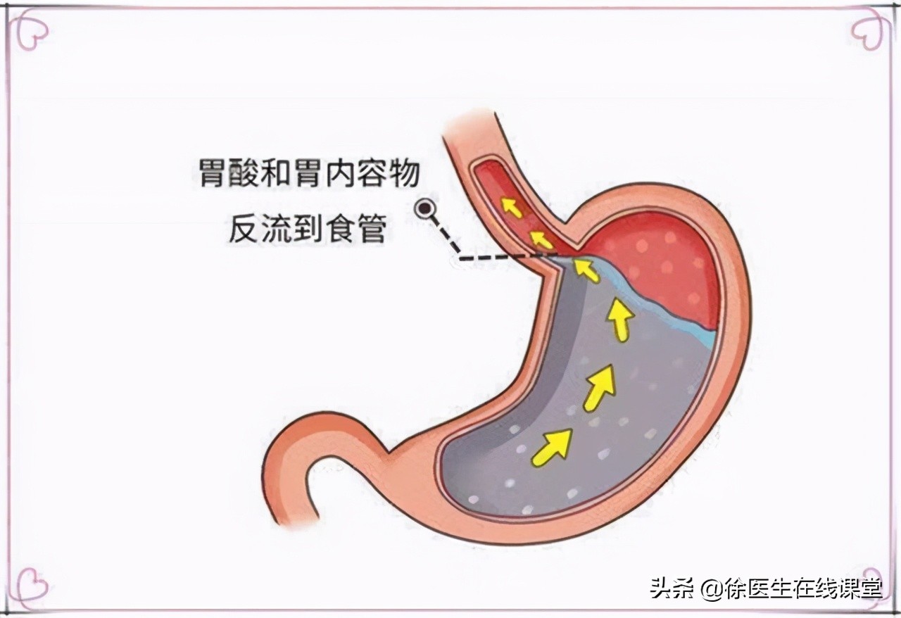 胃病患者想要根治幽门螺杆菌，二联疗法和四联疗法哪一个更优秀？