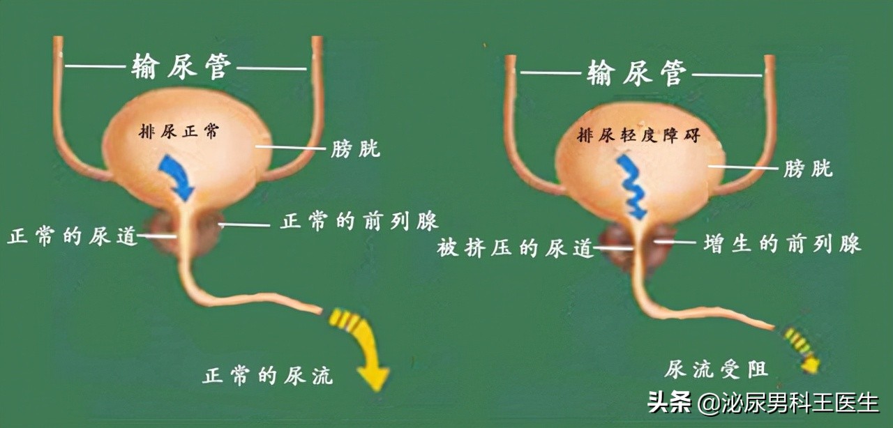 中老年人得了前列腺增生应该怎么办？