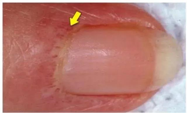 儿童的皮肌炎、多发性肌炎的诊断与鉴别诊断（下）