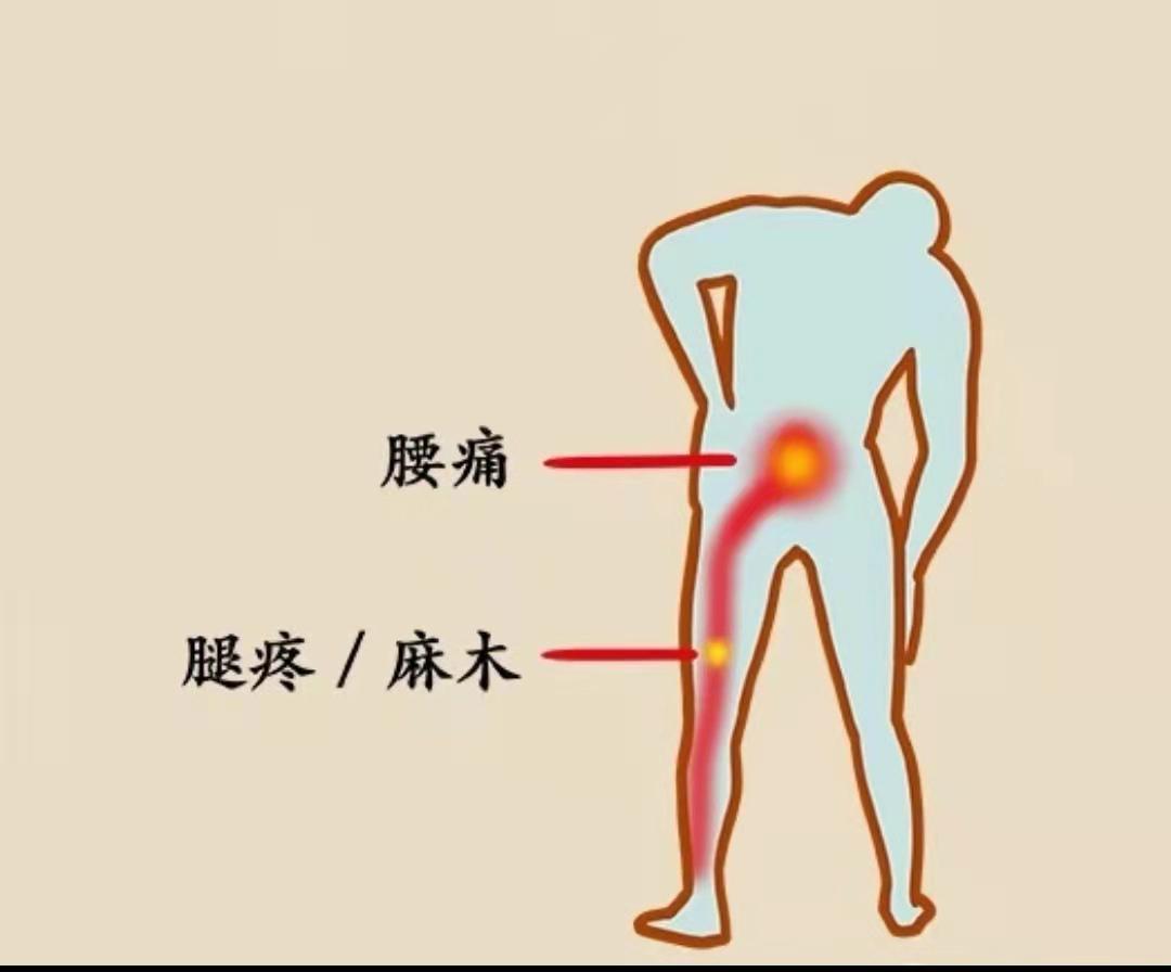 腰疼還是腎疼?醫生 1 招教你分辨