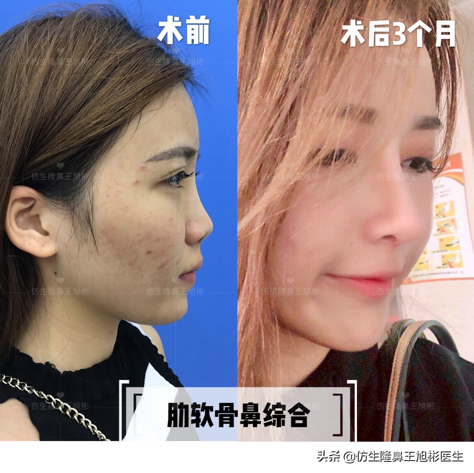 隆鼻方法那么多，你到底适合哪一种？