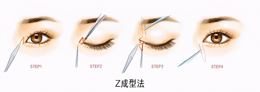 浅谈内眦赘皮之——如何避免开内眼角术后留疤