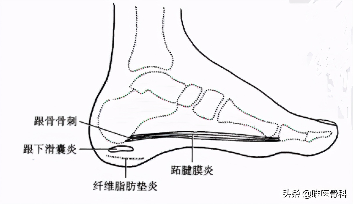 40-60岁容易出现的「 足跟疼 」，小心是这 3 种原因