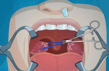 男子摘了扁桃體卻迎來銀屑病,扁桃體到底是不是
