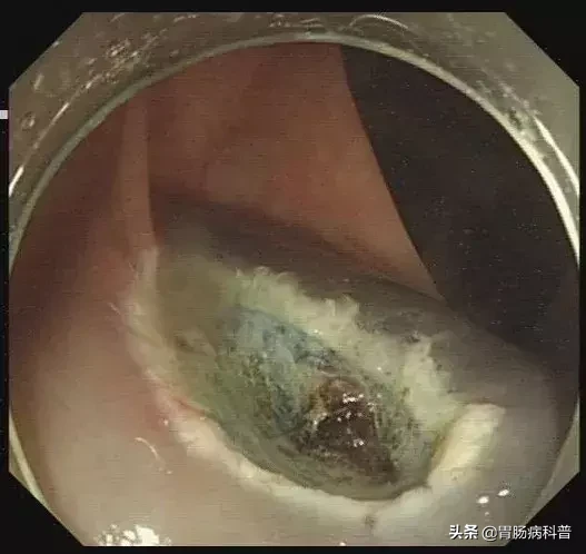 医生是怎样切掉肠息肉的?