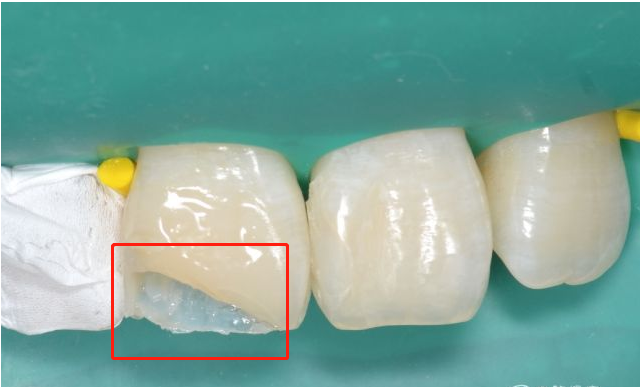 牙齿掉渣是什么原因？牙釉质脱落要重视，别因为侥幸毁了一口牙