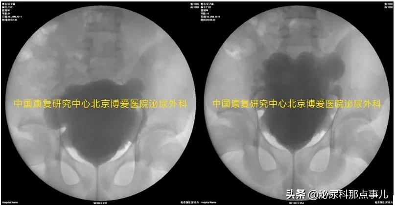 肠道膀胱扩大典型病例解析 | 神经源性下尿路功能障碍专栏 027