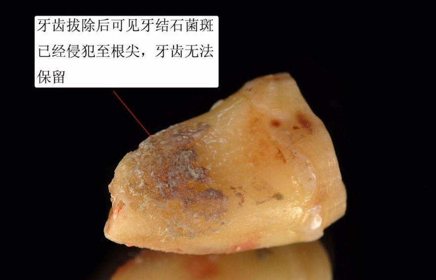 牙齿掉渣是什么原因？牙釉质脱落要重视，别因为侥幸毁了一口牙