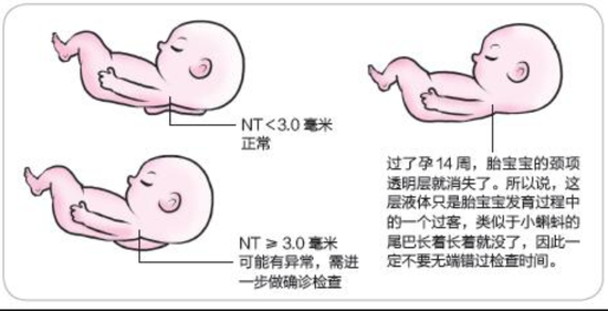 怀孕3个月产检查出NT增厚，孩子还能要吗？NT检查到底是什么？