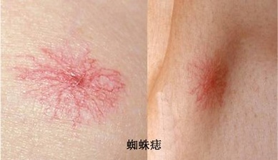 皮肤长红痣，说明肝病上身了？辟谣：很多人都弄错了