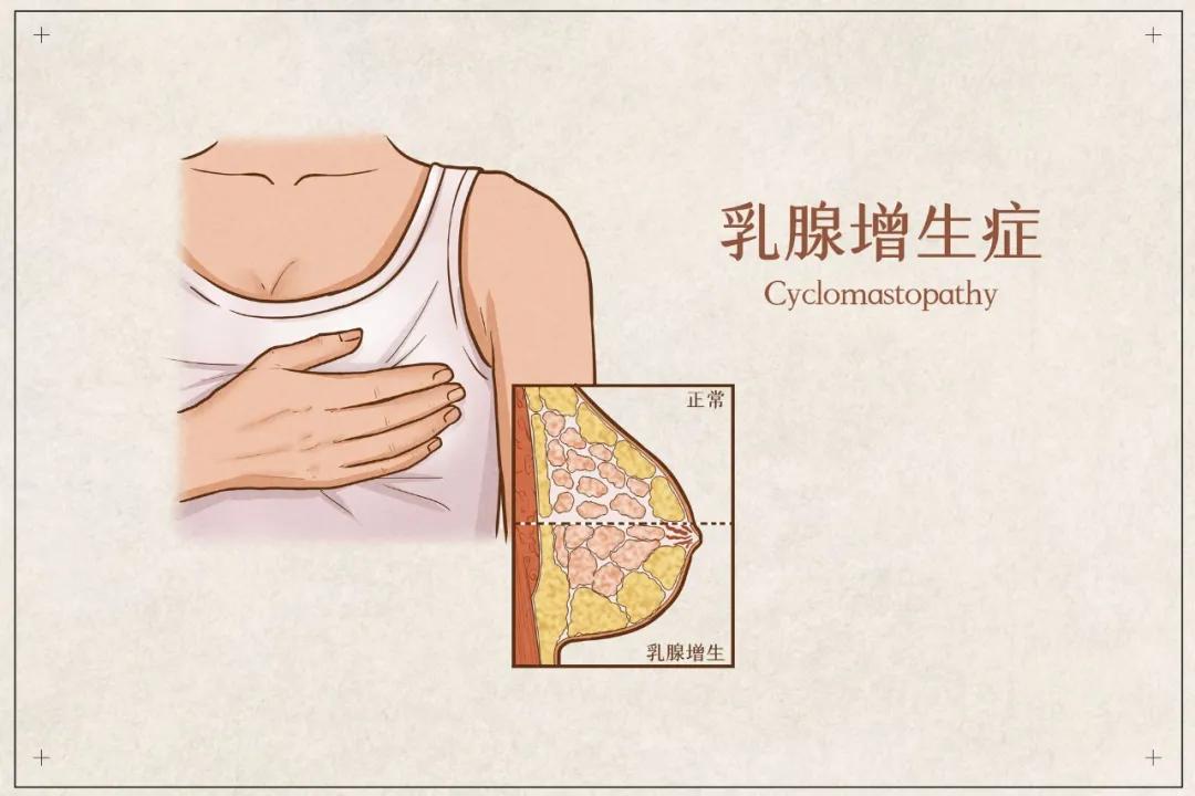 乳腺增生这件事！除了生活习惯改变，还有这些用药