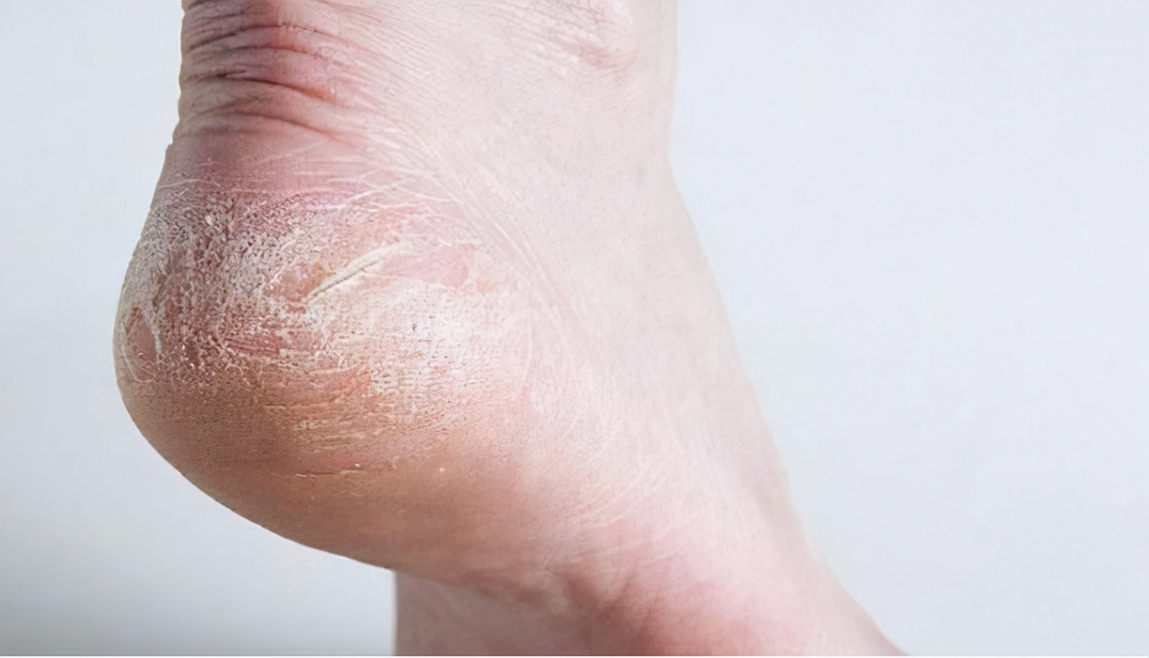 糖尿病来临的时候,足部常常会有3种变化,你知道吗?