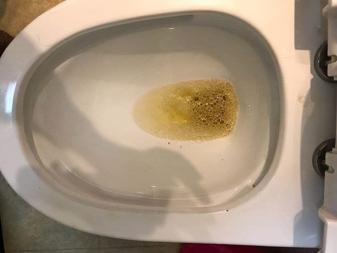 排尿有泡沫是怎么回事?与肾脏健康有关吗?