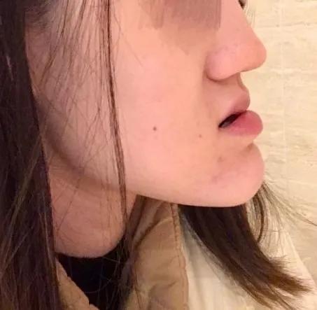 都说矫正要趁早,成年后地包天还有救吗?