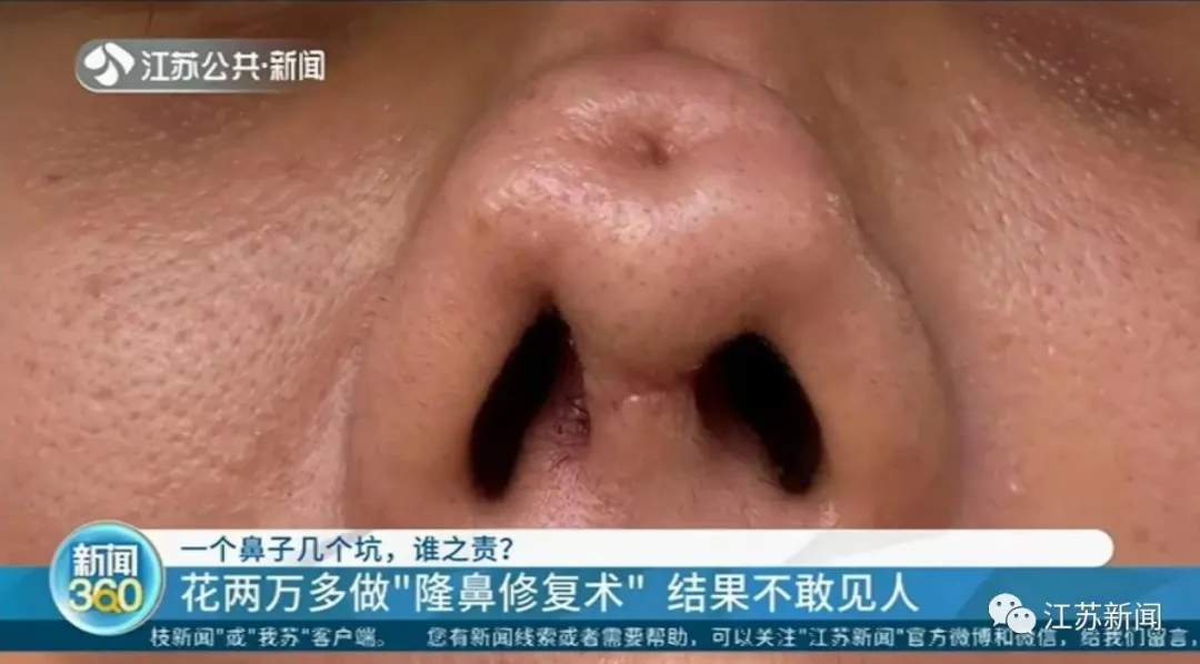 女主播花2万多做“隆鼻”,整完鼻子变4个洞